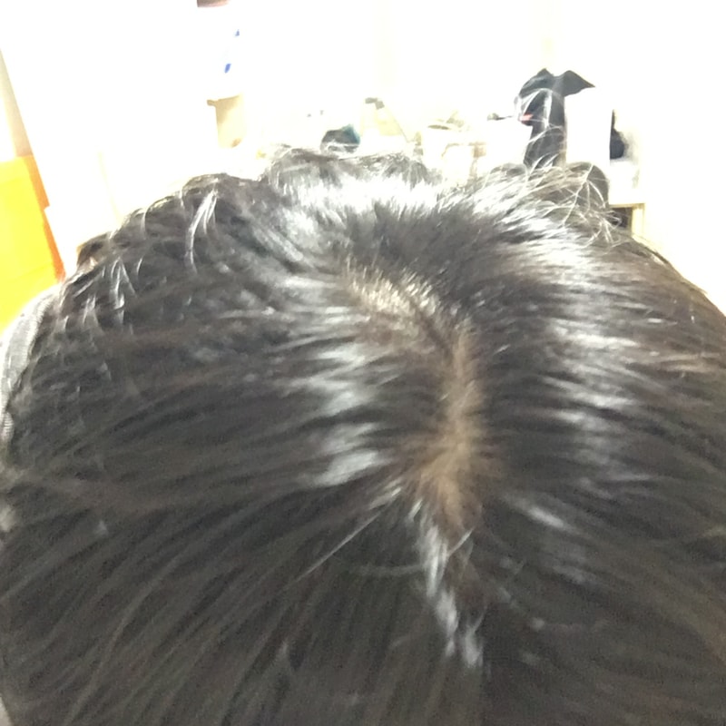 진짜 뻑 탈모입니다..