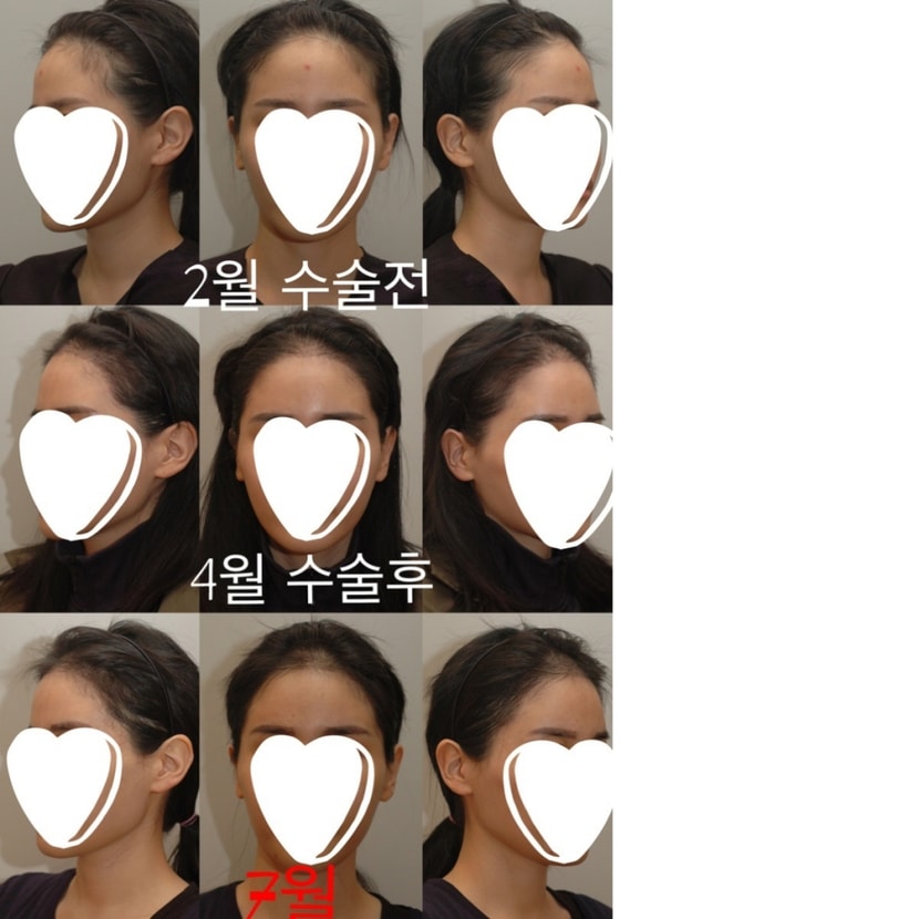 수술 전,후