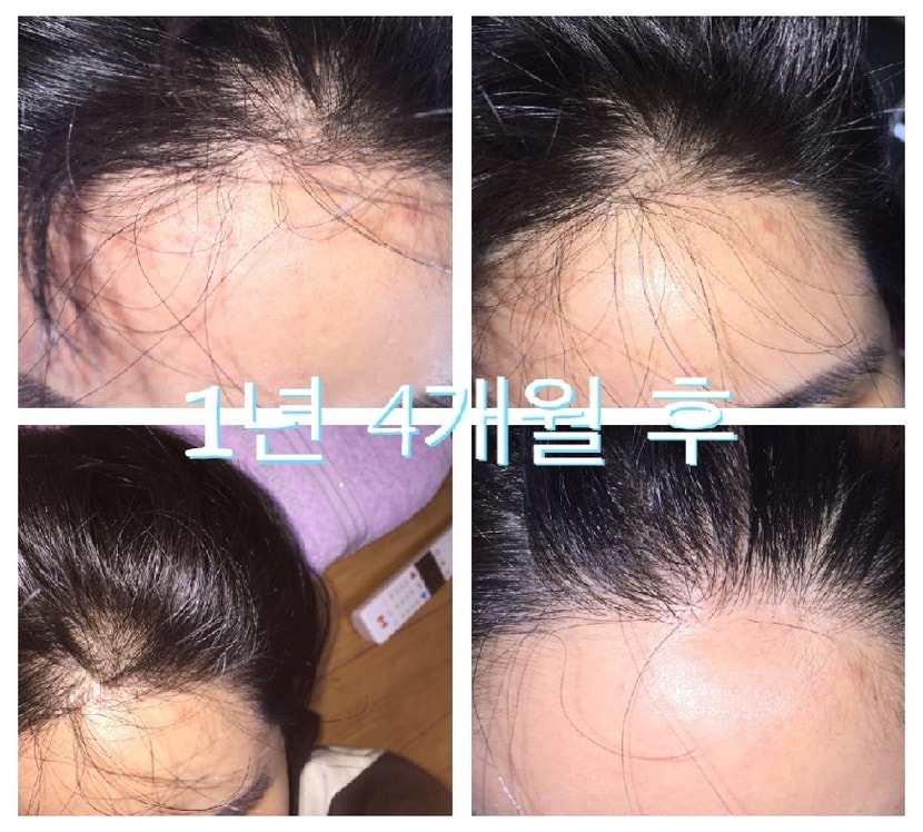 수술후 1년 4개월 