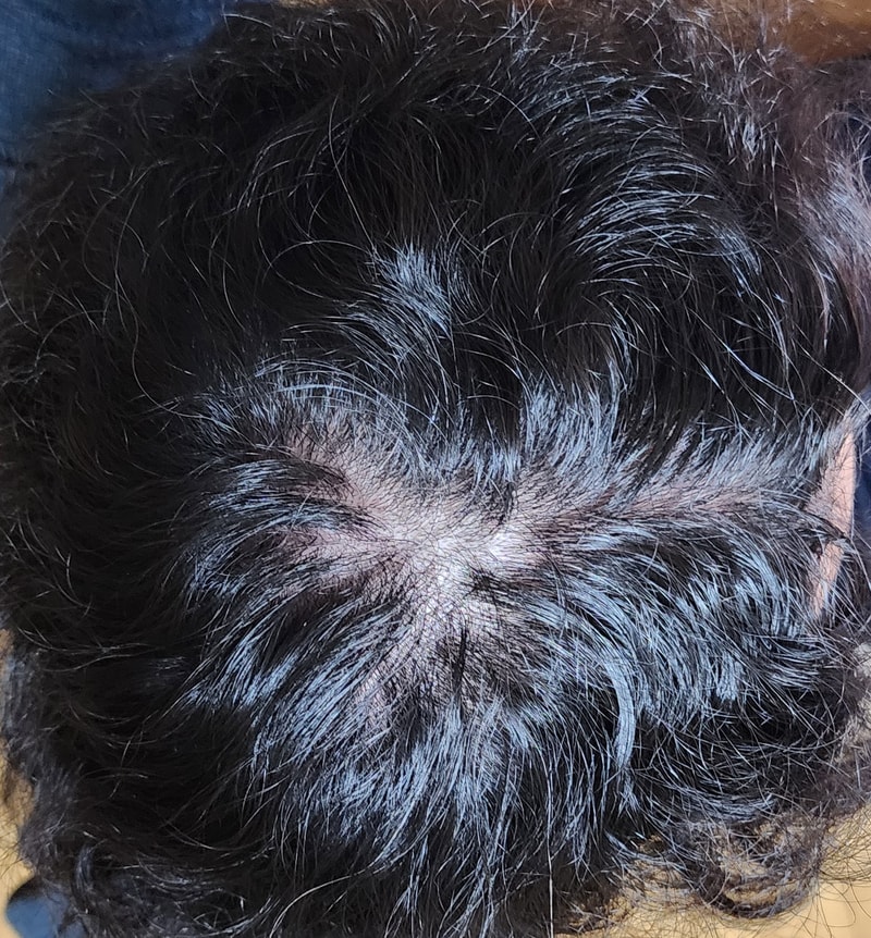 この程度なら薄毛中期ですか？