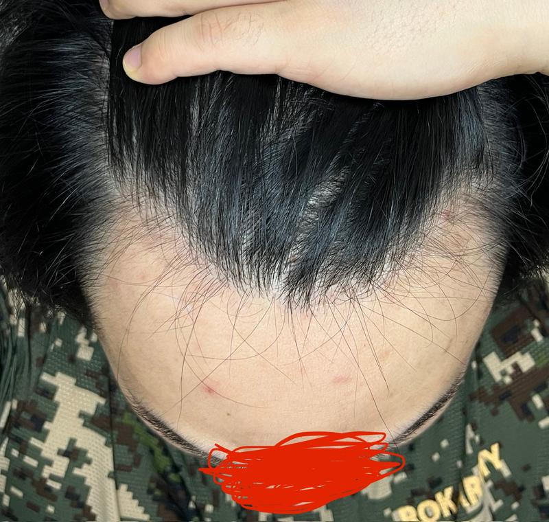 薄毛症のお悩み 20代前半