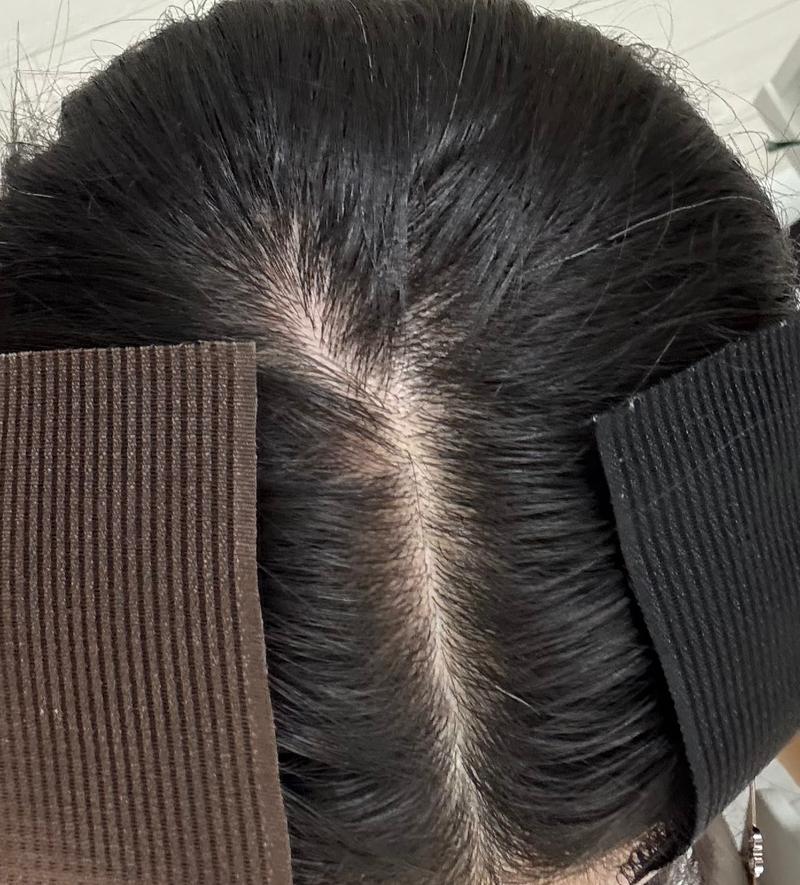 20代の女性の薄毛でしょうか…···