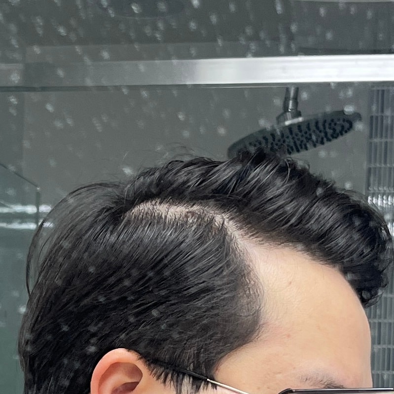 Can I have a hair transplant this year