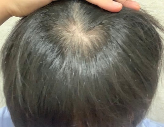 前頭部薄毛