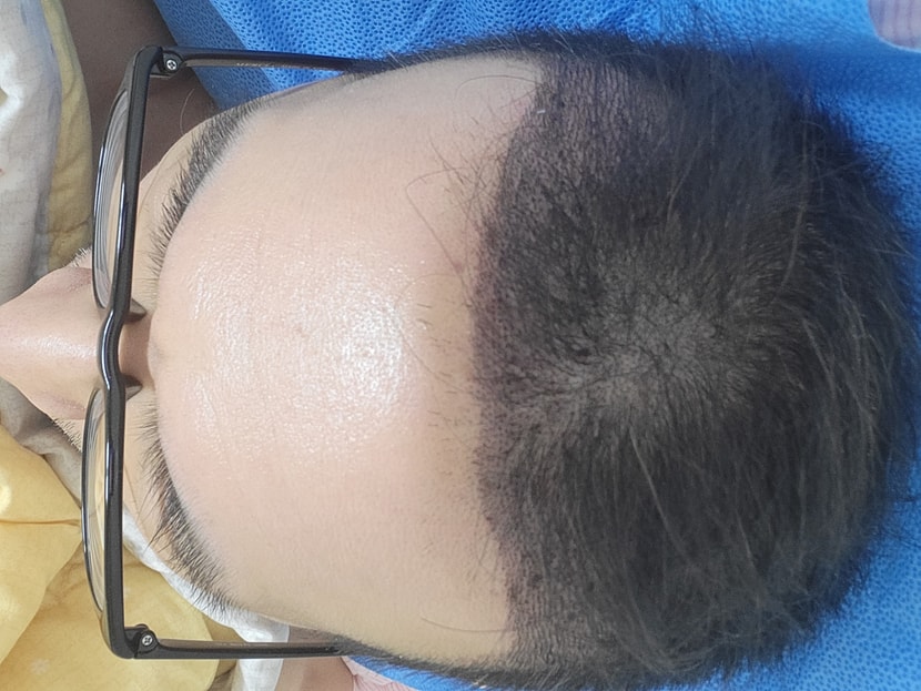 모발이식 후 1일차