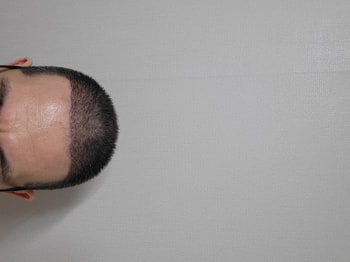 모발이식 후 3주차