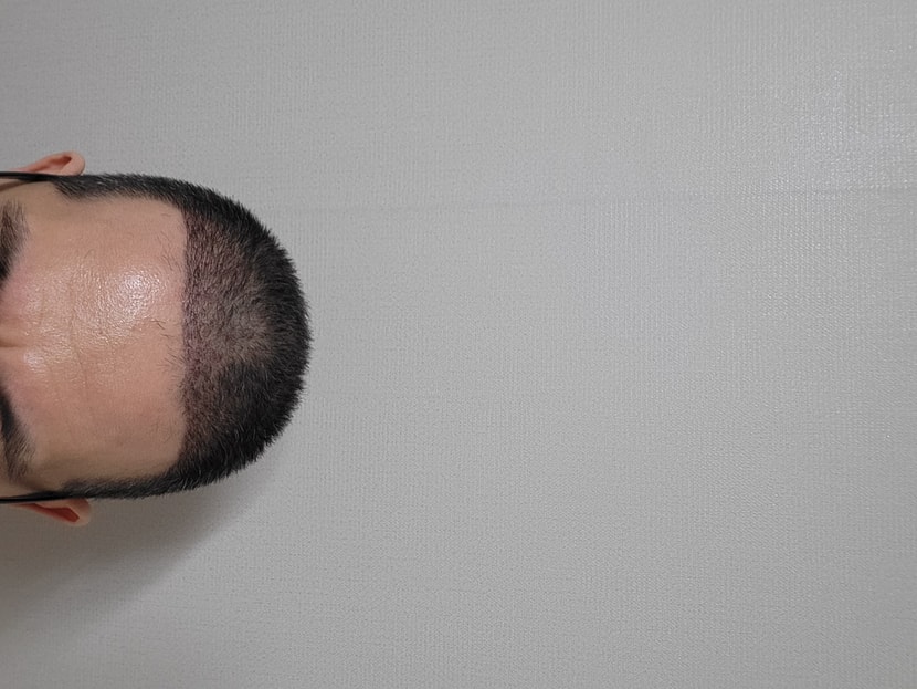 모발이식 후 3주차