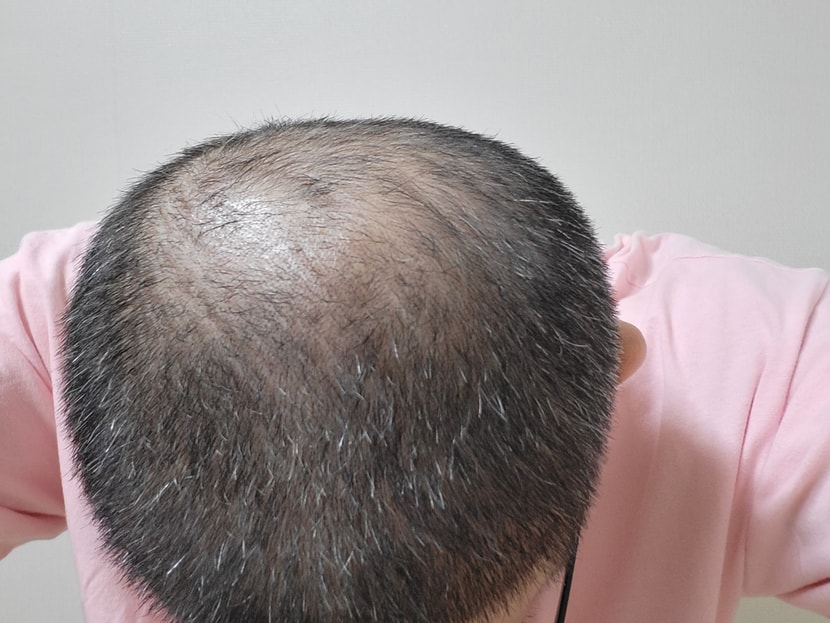 아보다트 복용 후 한달. 복용 전 사진이 있었는데 꼴보기 싫어서 지웠었나 봐요....