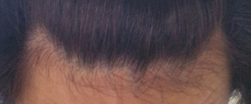 반년전 이마입니다