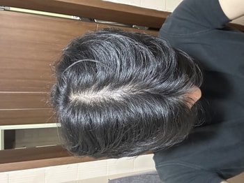 해당 사진은 작년 10월? 처음으로 탈모 의심으로 찍어둔 사진입나다
