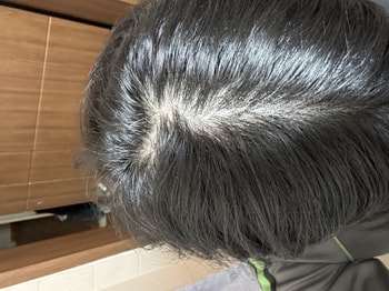 이건 약먹기 시작하고 3개월쯤 지났을때 입니다