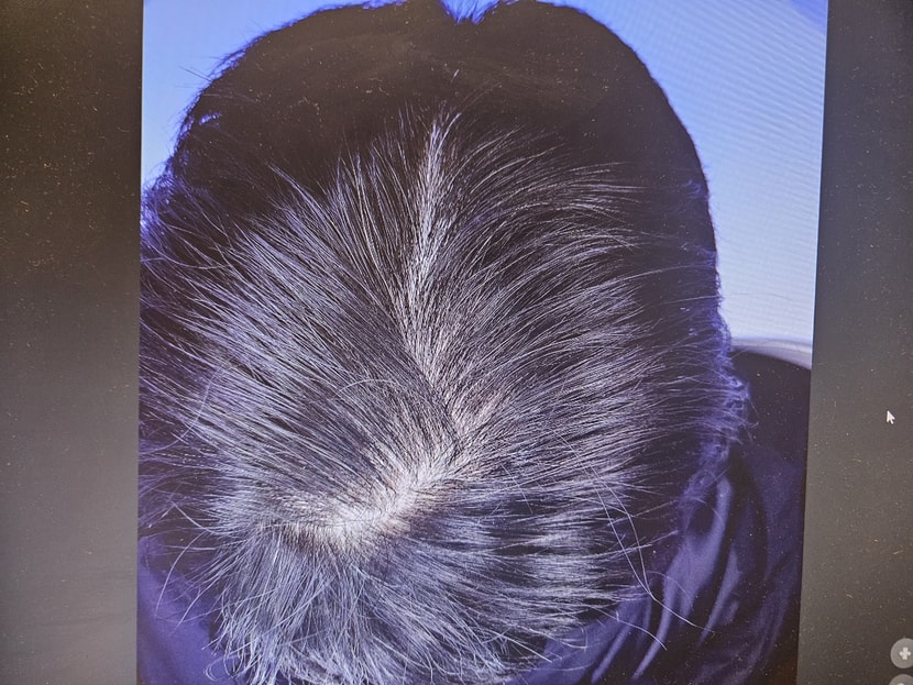 병원 기계로 찍은사진입니다(가르마 빗으로 가르고 촬영함)