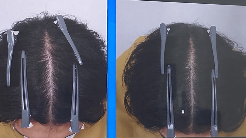 注射治療10回後記