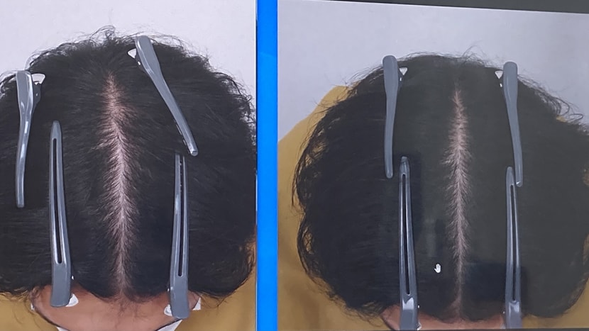 왼쪽 ( 전 ) 오른쪽 ( 후 ) 