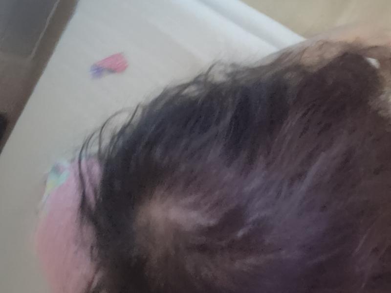 저 탈모인가요 ㅠㅠㅠ