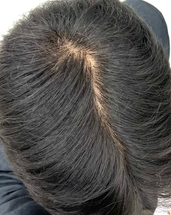 치료 후