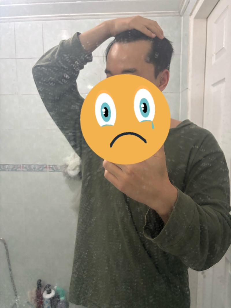 탈모 판단 좀 부탁드려요