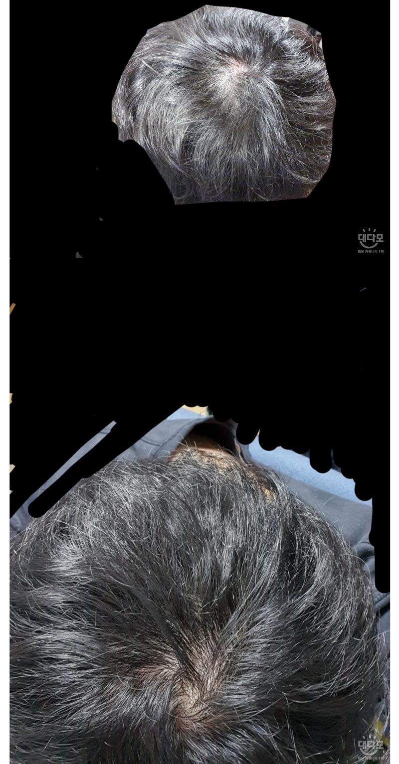 뉴헤어 검사 후기