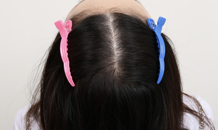 치료후 가르마 모습입니다