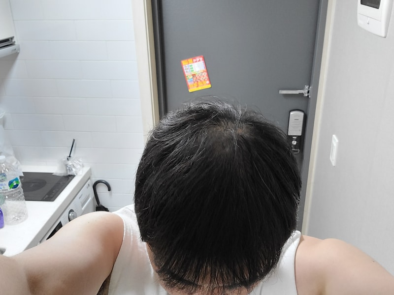 31세 탈모로 엄청고민하고 있습니다.씨엠프로