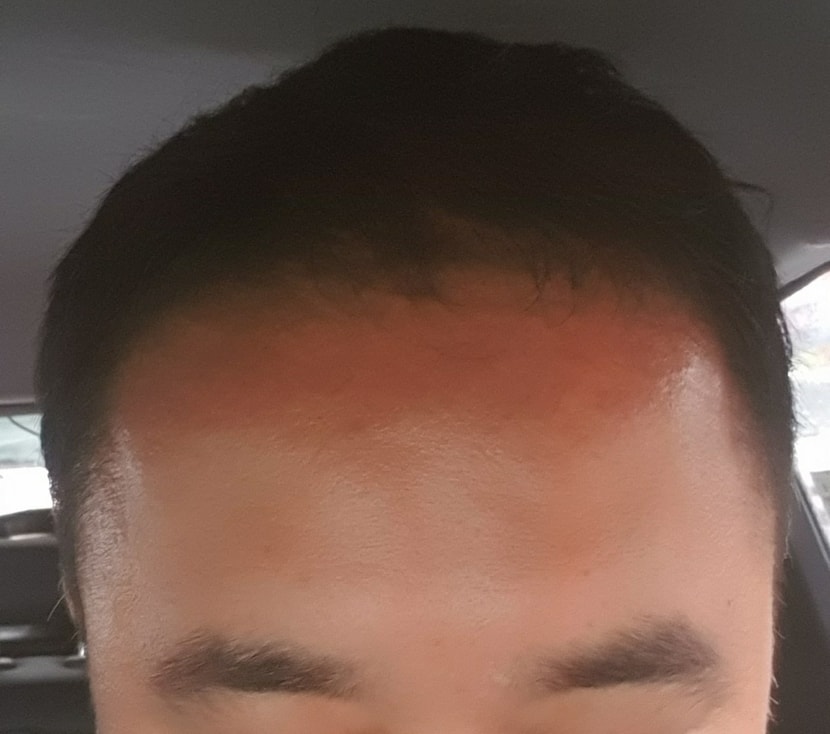 관리후 모발 사진입니다 