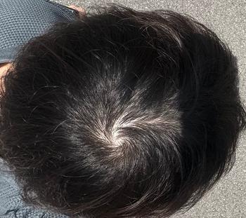 머리카락이 얇고 현재 헤어그로정 복용중입니다 어떤식으로 관리해야할까요ㅠㅠ