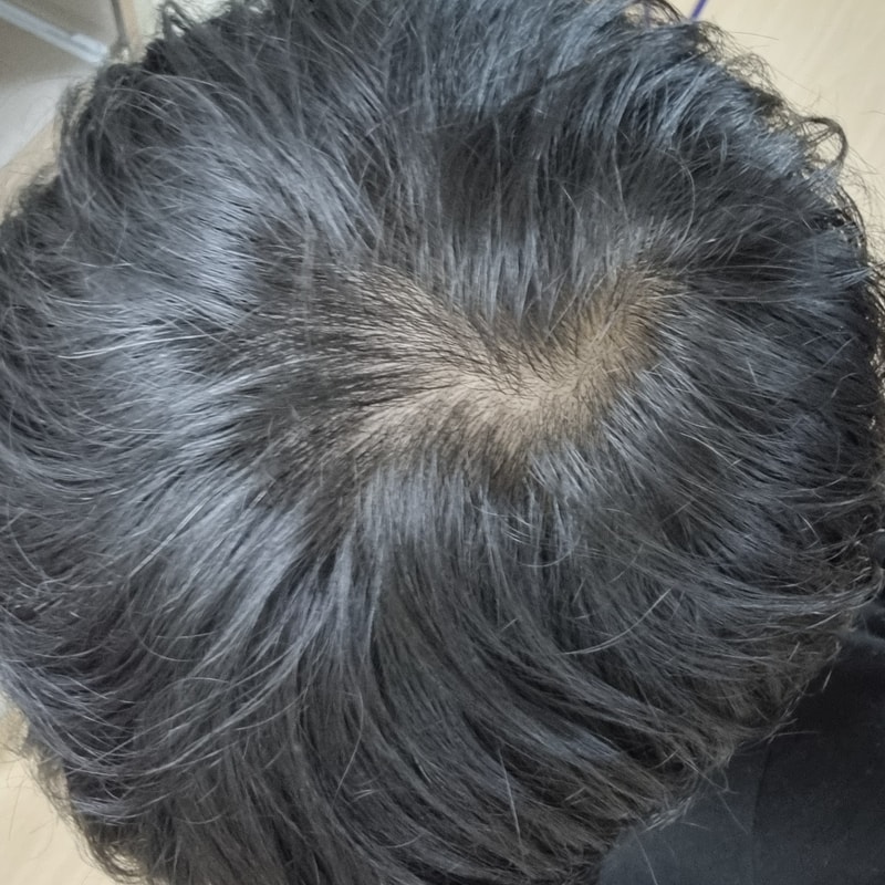 頭頂部薄毛8ヶ月目、いつ頃薬効が出るでしょうか..