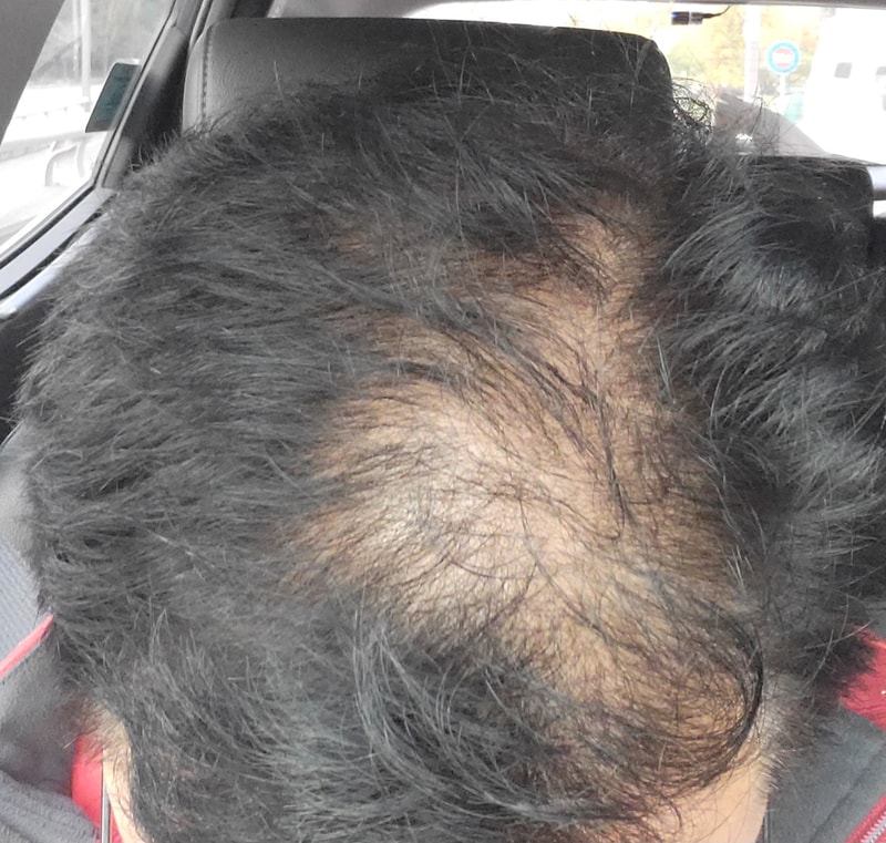 동탄 ㅎㅇㄹ 탈모치료 플래티넘 2회차 후기