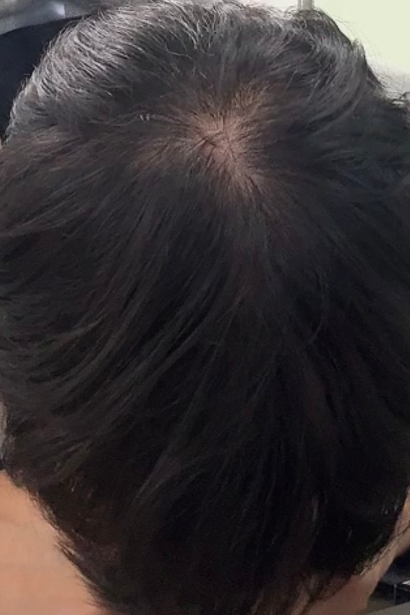 关于服用脱发药