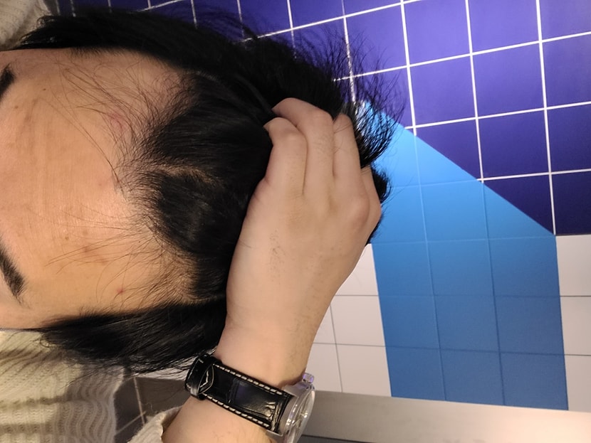 이지경이 되도록왜안가 라고 생각하시겠지만 사실 날때부터 m자였습니다... 다만 이마가 넓어지는거같아서 병원가보려고합니다