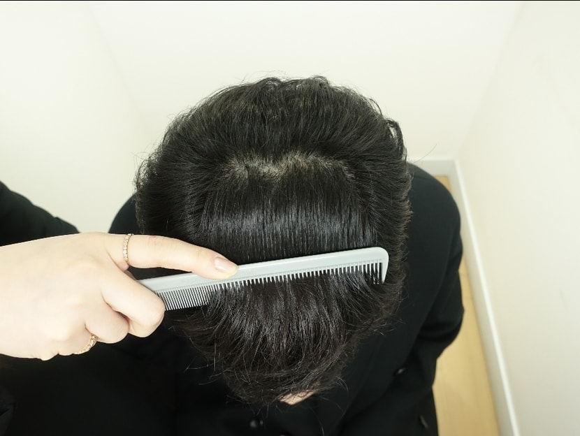 더적은2000모 심었는데 4개월차 만족더높은 타병원수술