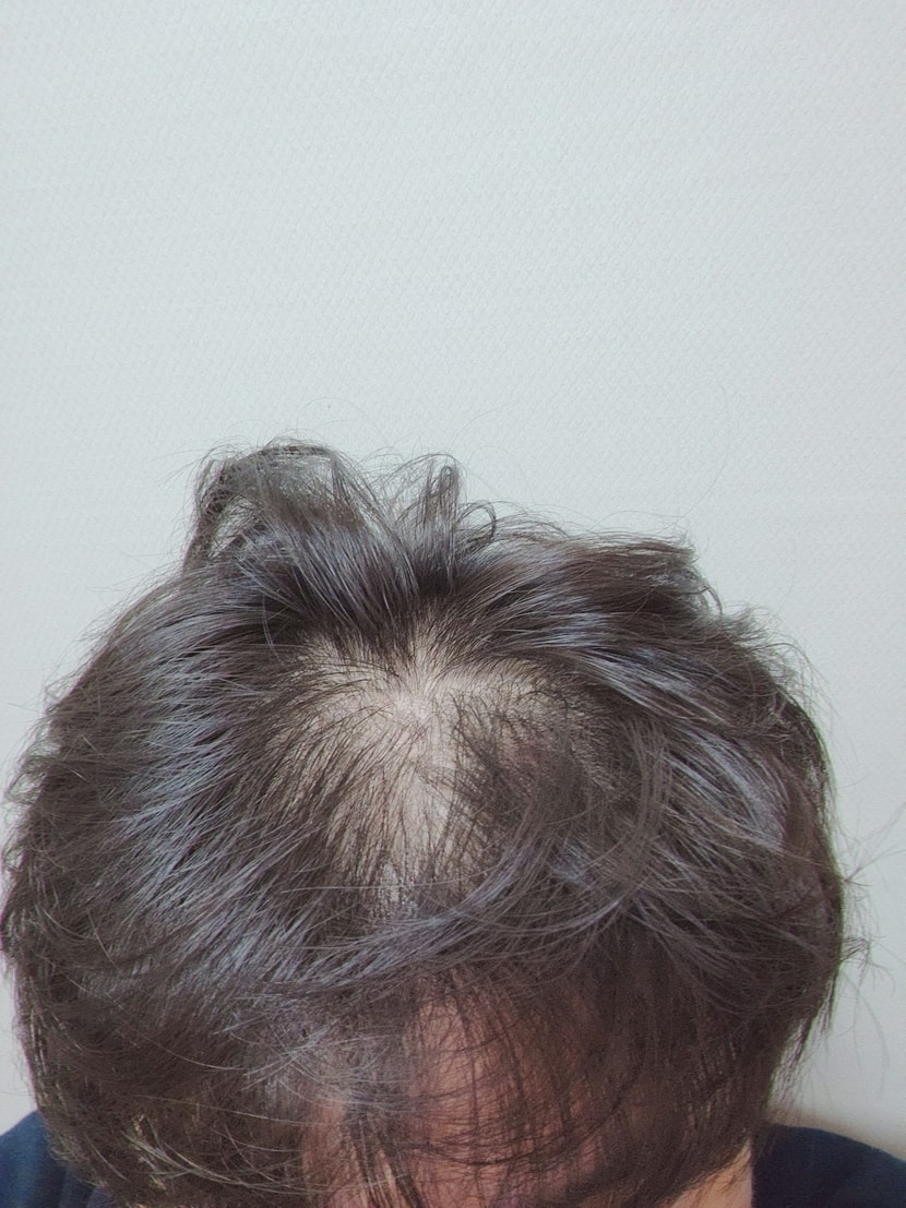 윗머리 살짝 들췄을때