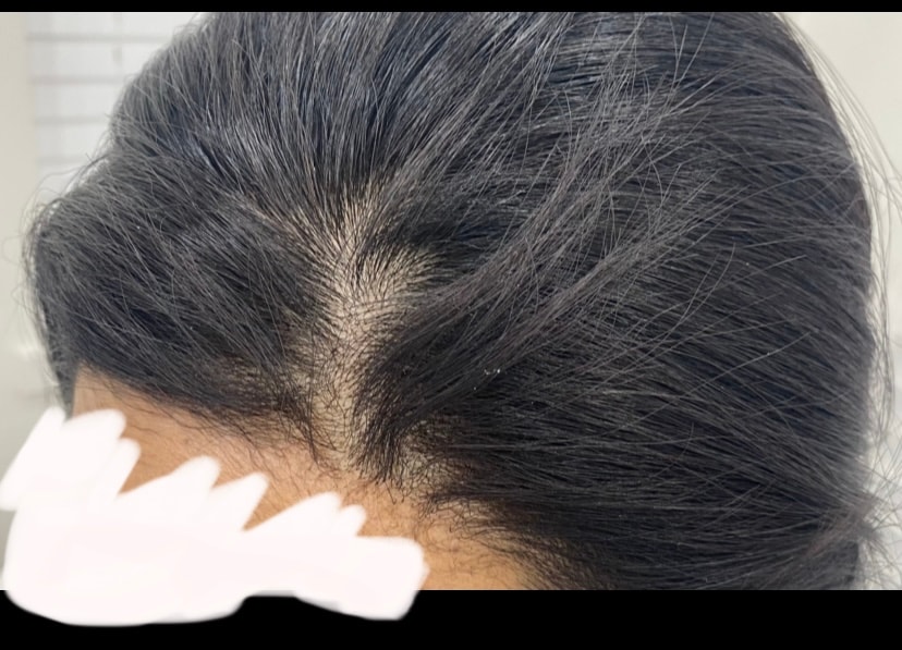 시술 다음날 찍은 사진입니다