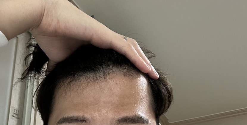 프페 복용 6개월차