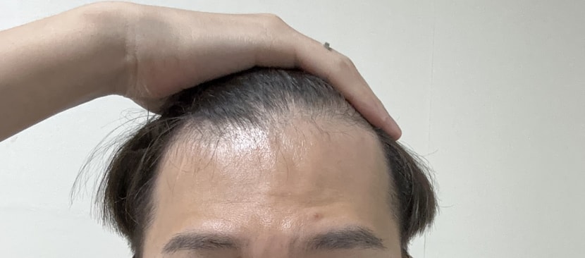 프페 복용 2개월차