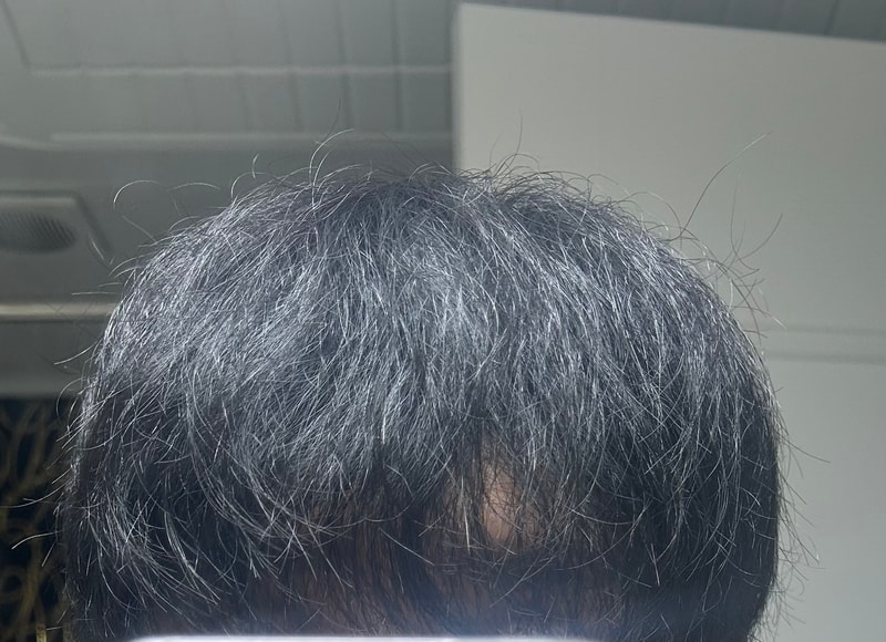 AGA治療薬食べて恋慕花