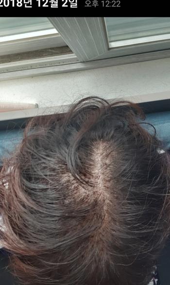 모발이식단계 사진 