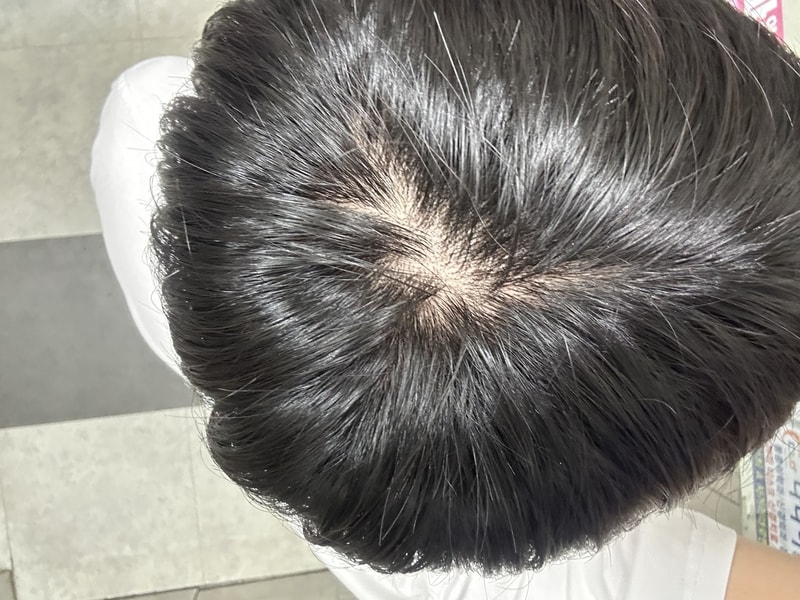 막 20대 정수리 탈모 기록