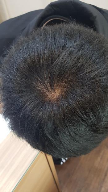 3년전 정수리