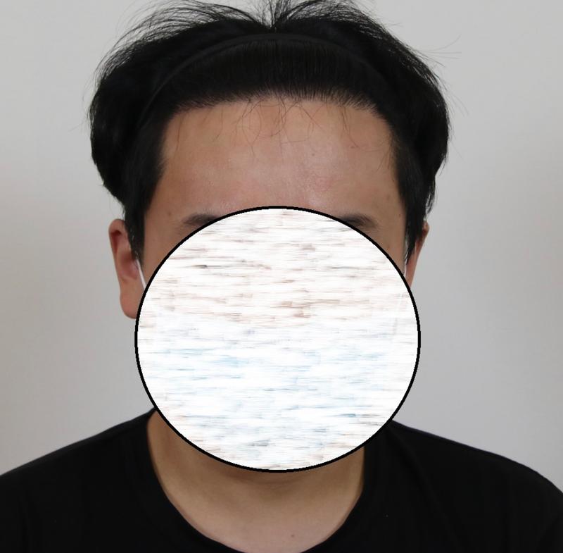 分享我在手术医院苦恼后决定的内容吧（Mammos）