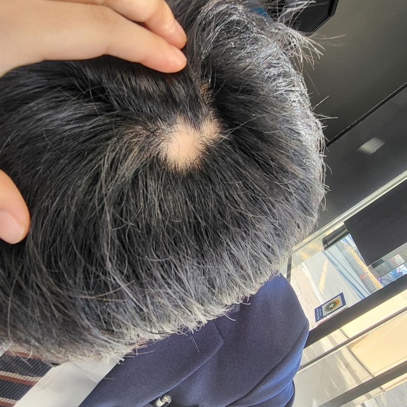 원형탈모 5개월차 ㅠㅠㅠ