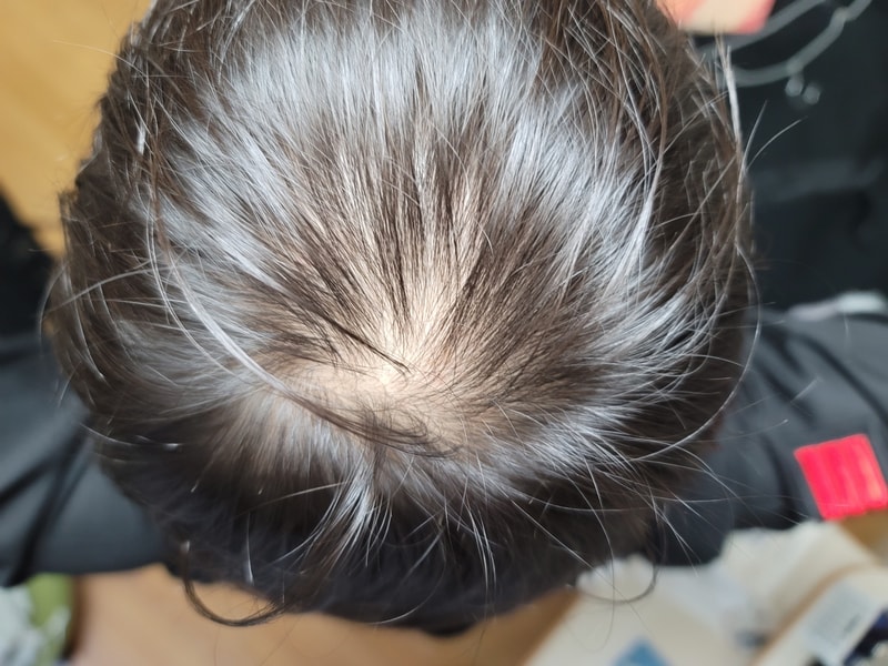 1년먹으면 좋아질거 같나요? ㅠ..