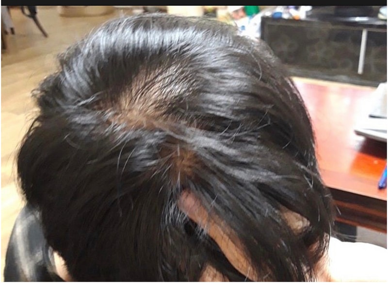 30살 정수리 탈모 진행현활