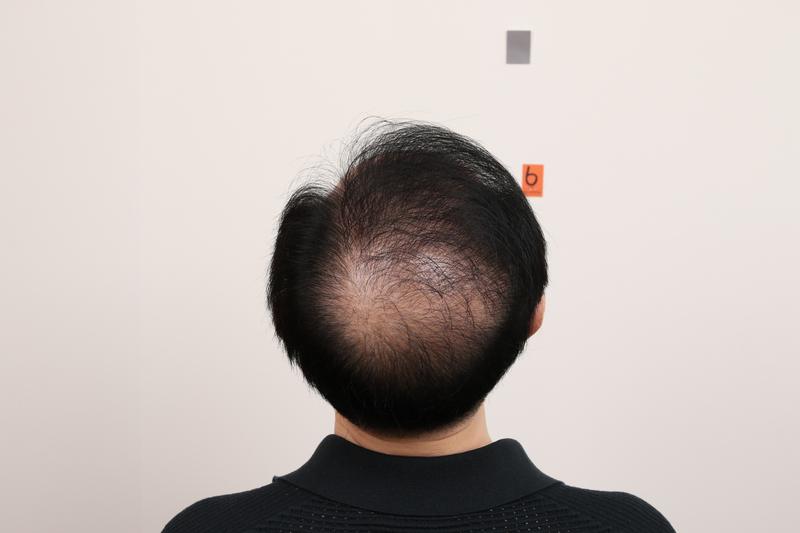 釜山脱发治疗留有Regenera Activa Mammos效果。 我是秃头..