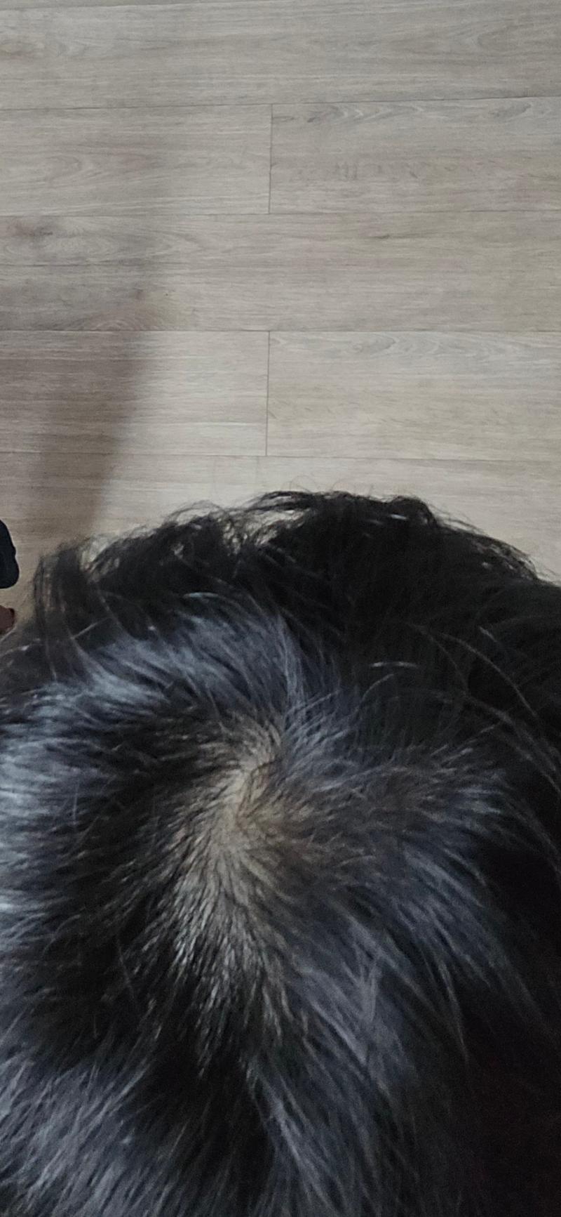 이정도면 탈모가 맞았겠죠?