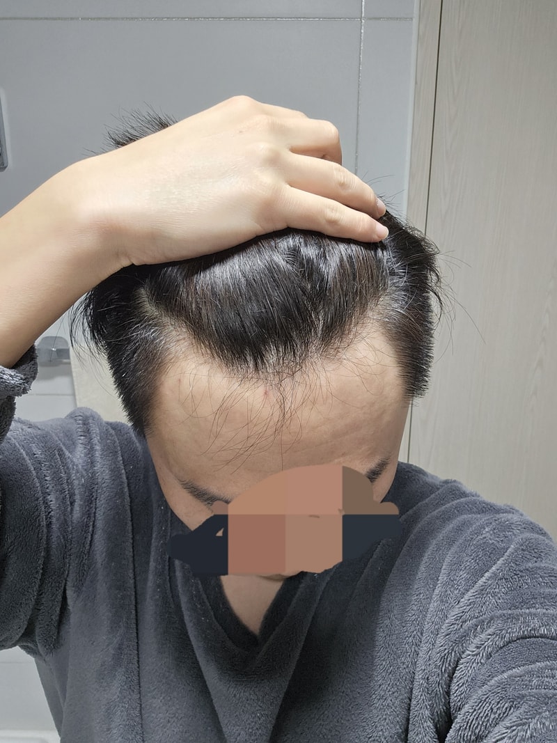 薄毛診断をお願いします