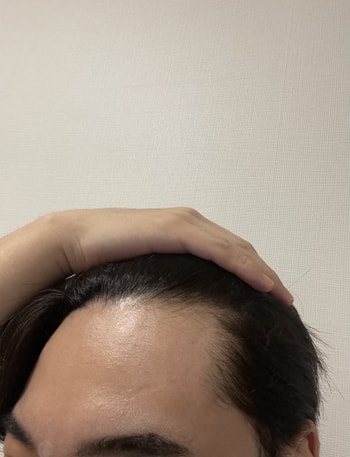 오른쪽이마입니다