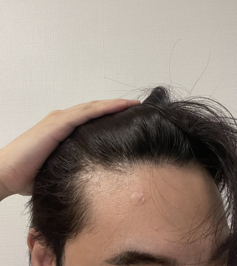 M자 탈모 진행중일까요?