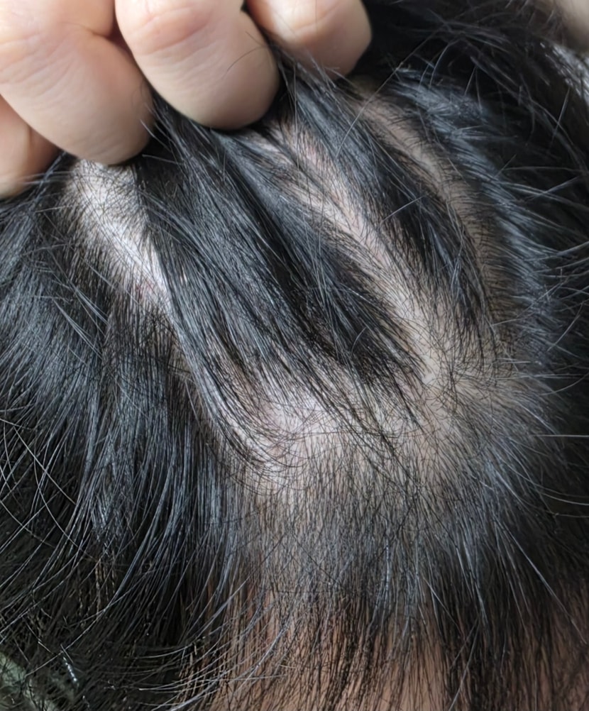 정수리 기준 우측 대각선 부분