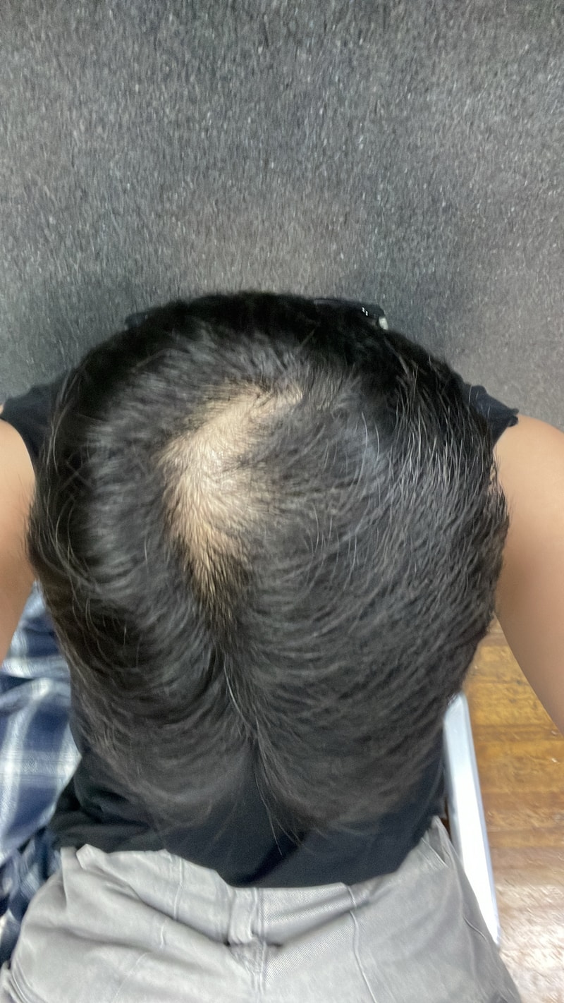 20대 남자 정수리 탈모 회복 가능할까요.. ( 심함 )